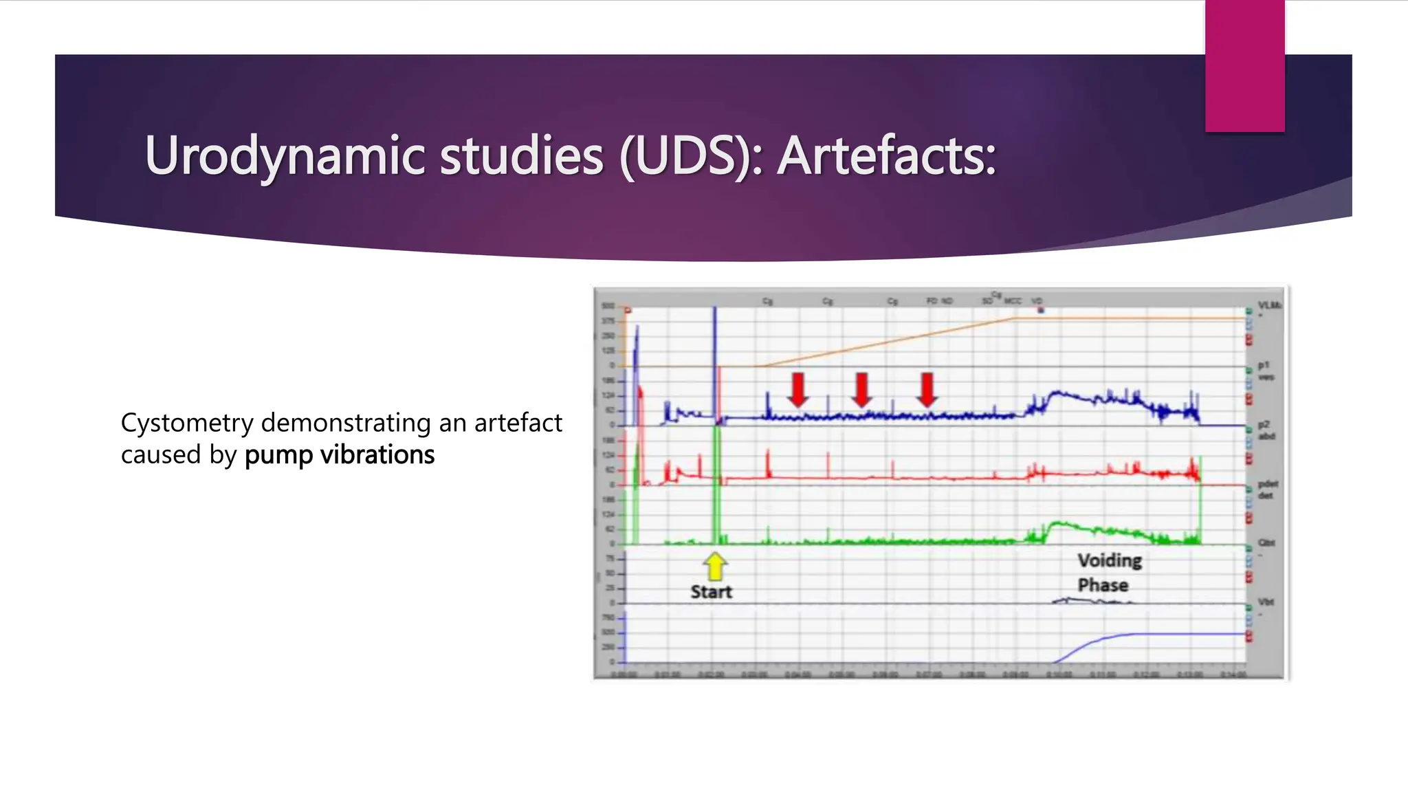 Urodynamic studies (UDS): Artefacts:
Cystometry demonstrating an artefact
caused by pump vibrations
 