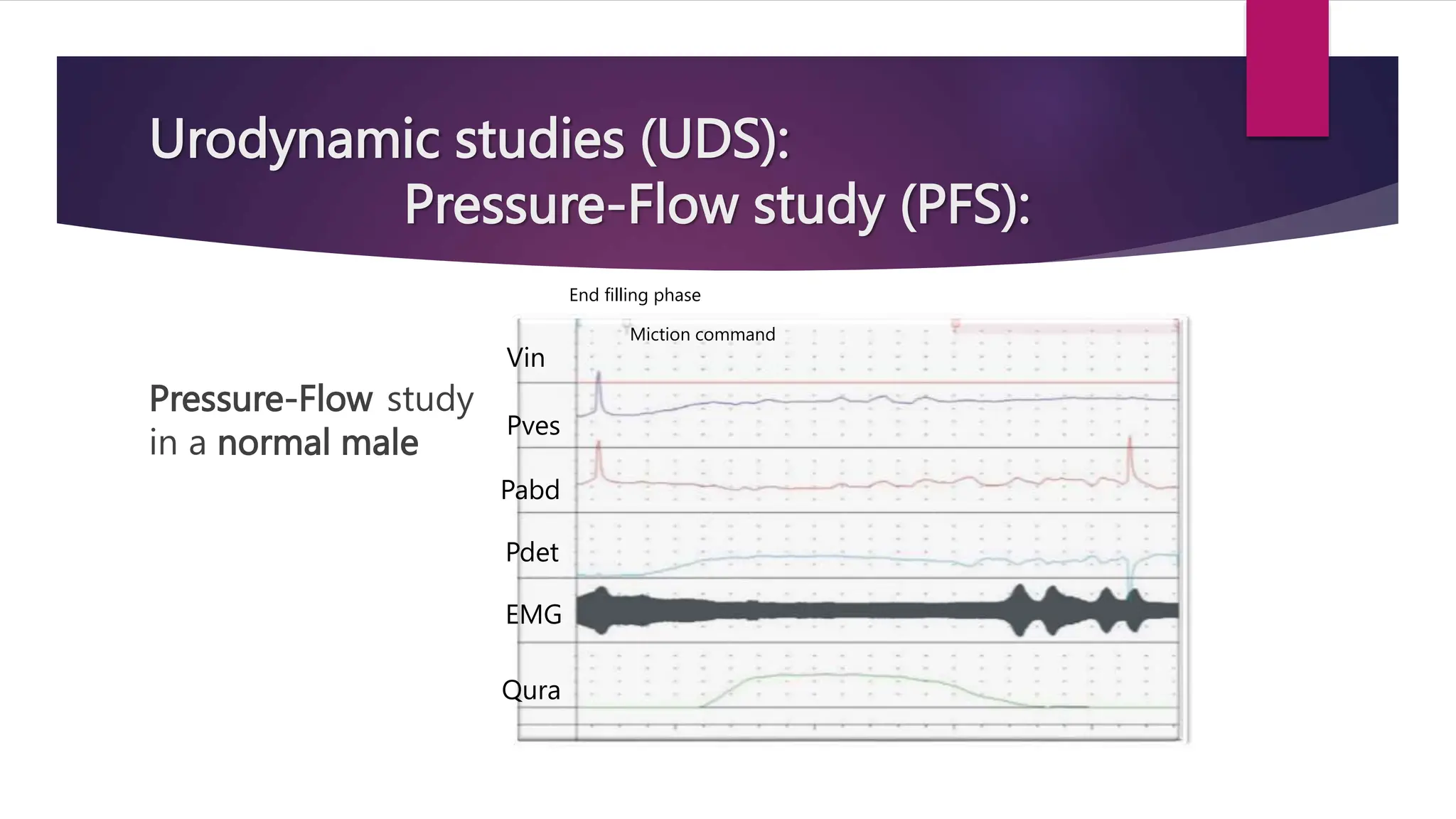 Urodynamic studies (UDS):
Pressure-Flow study (PFS):
Pressure-Flow study
in a normal male
Vin
Pves
Pabd
Pdet
EMG
Qura
End filling phase
Miction command
 