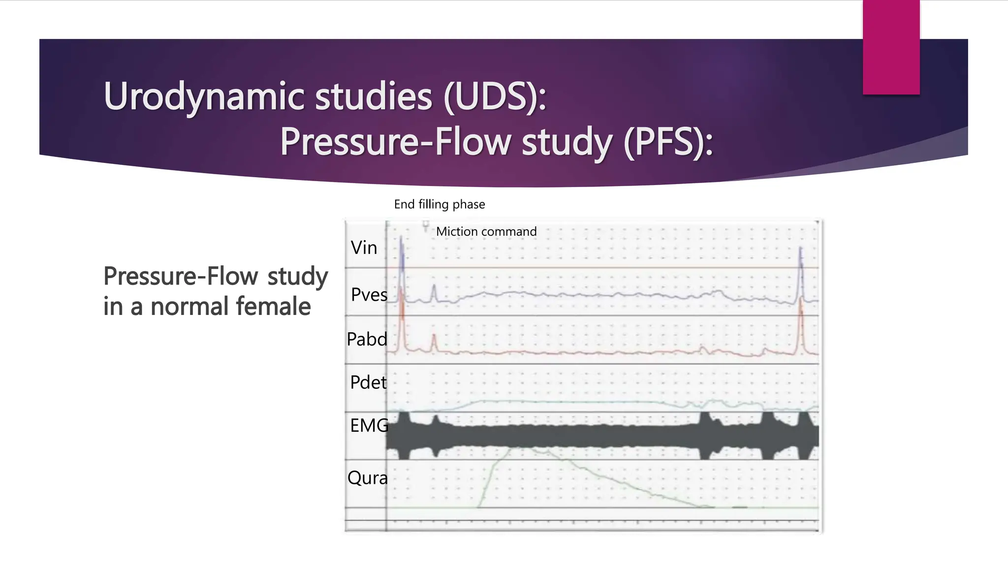 Urodynamic studies (UDS):
Pressure-Flow study (PFS):
Pressure-Flow study
in a normal female
Vin
Pves
Pabd
Pdet
EMG
Qura
End filling phase
Miction command
 