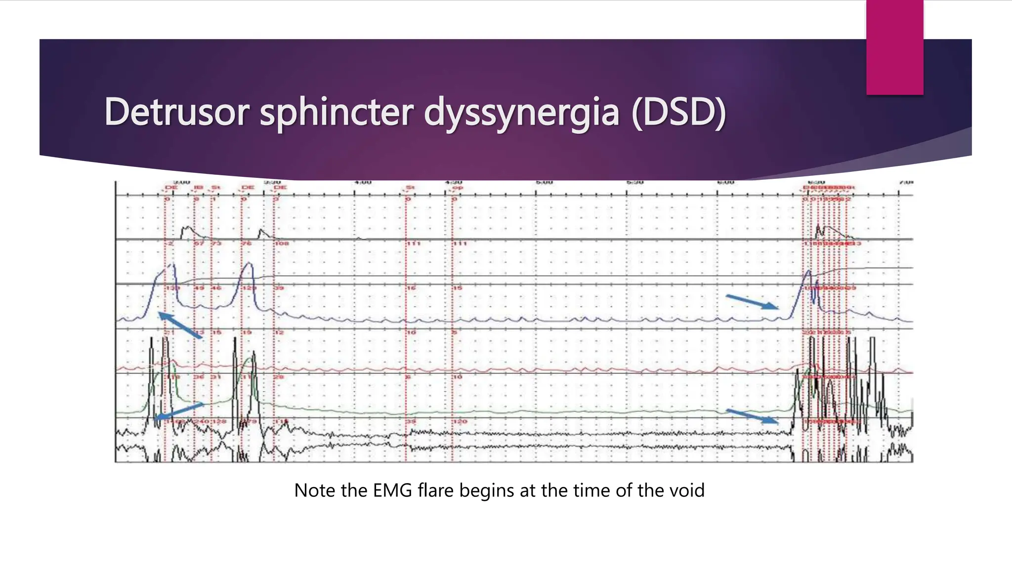 Detrusor sphincter dyssynergia (DSD)
Note the EMG flare begins at the time of the void
 