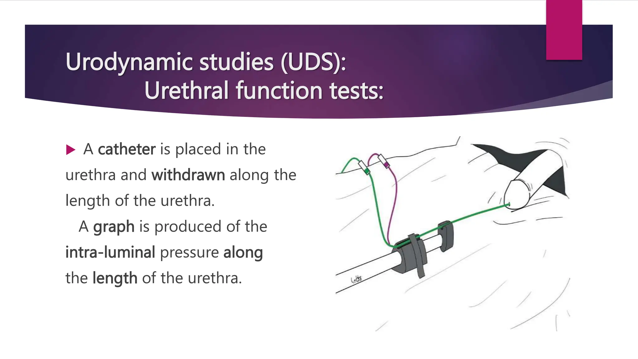Urodynamic studies (UDS):
Urethral function tests:
 A catheter is placed in the
urethra and withdrawn along the
length of the urethra.
A graph is produced of the
intra-luminal pressure along
the length of the urethra.
 