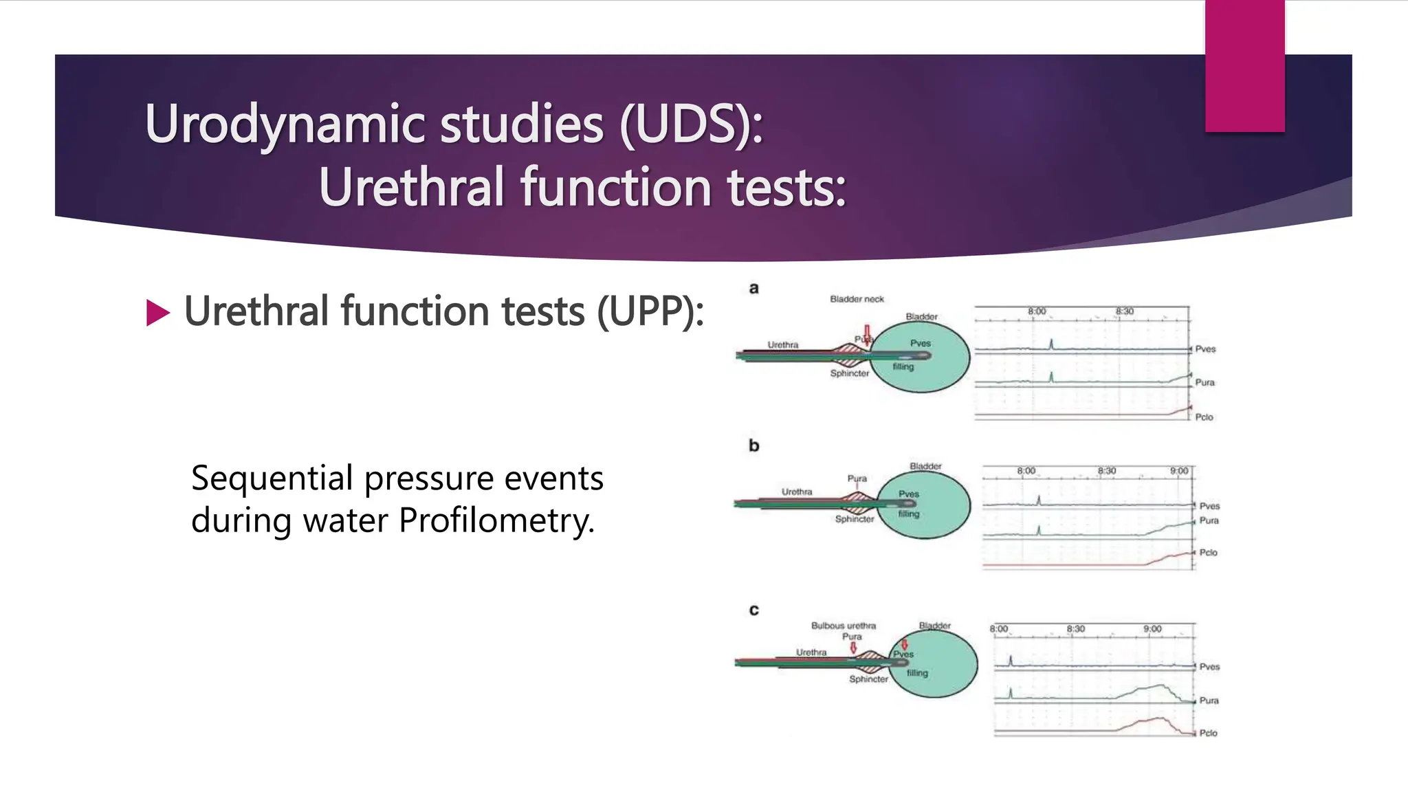 Urodynamic studies (UDS):
Urethral function tests:
 Urethral function tests (UPP):
Sequential pressure events
during water Profilometry.
 