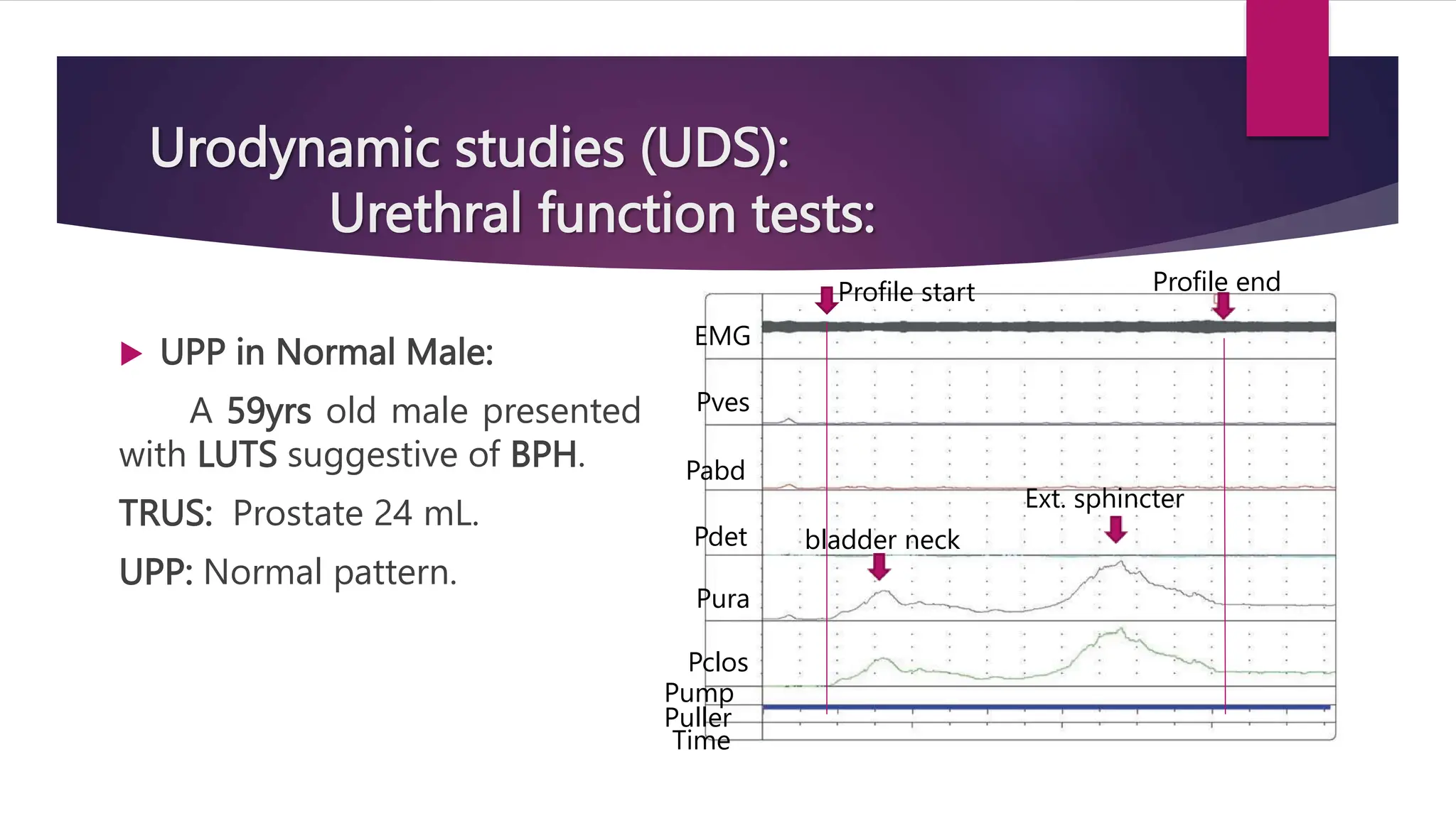 Urodynamic studies (UDS):
Urethral function tests:
 UPP in Normal Male:
A 59yrs old male presented
with LUTS suggestive of BPH.
TRUS: Prostate 24 mL.
UPP: Normal pattern.
Profile start
EMG
Pves
Pabd
Pdet
Pura
Pclos
Pump
Puller
Time
Profile end
bladder neck
Ext. sphincter
 