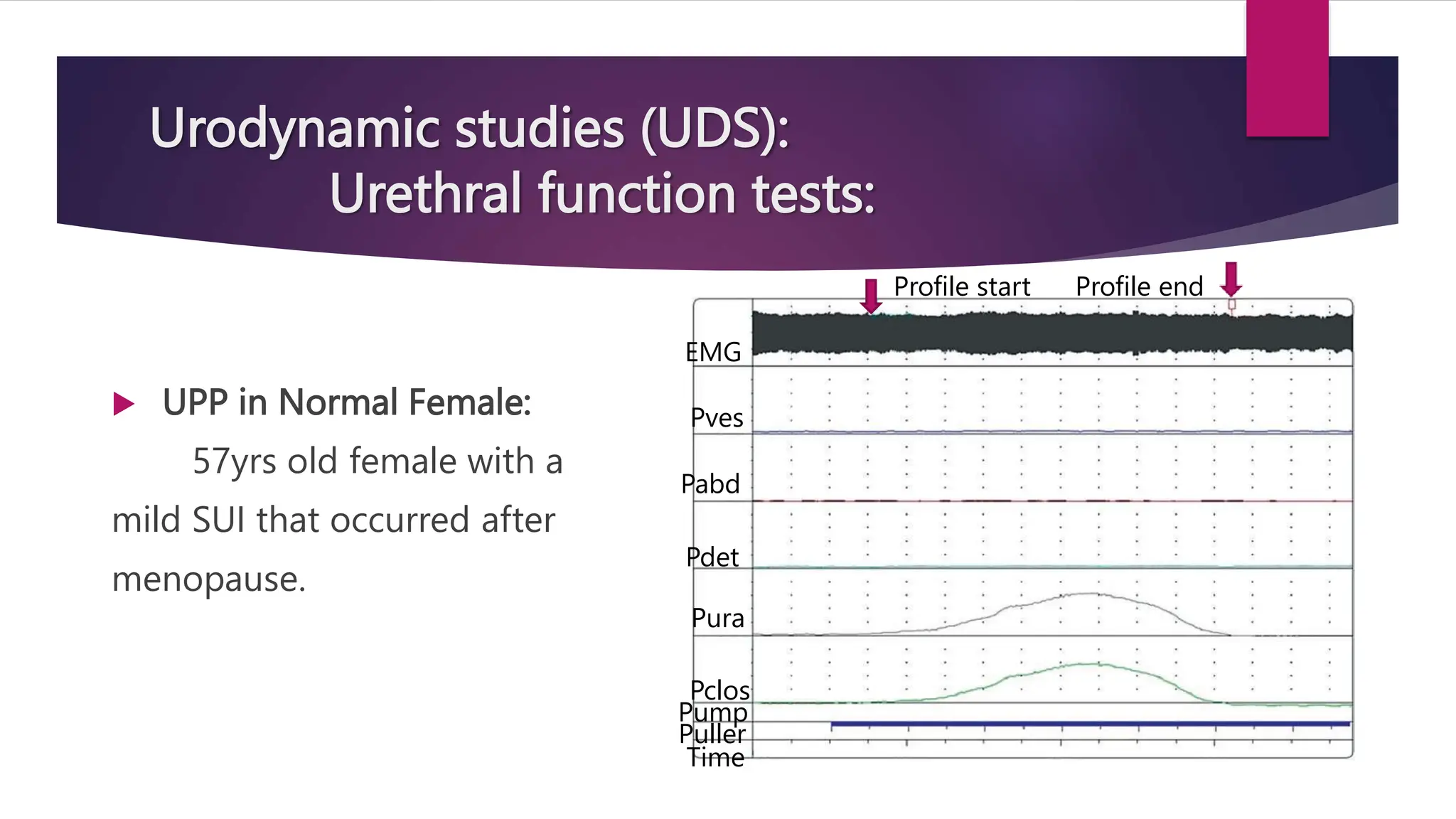 Urodynamic studies (UDS):
Urethral function tests:
 UPP in Normal Female:
57yrs old female with a
mild SUI that occurred after
menopause.
Profile start Profile end
EMG
Pves
Pabd
Pdet
Pura
Pclos
Pump
Puller
Time
 