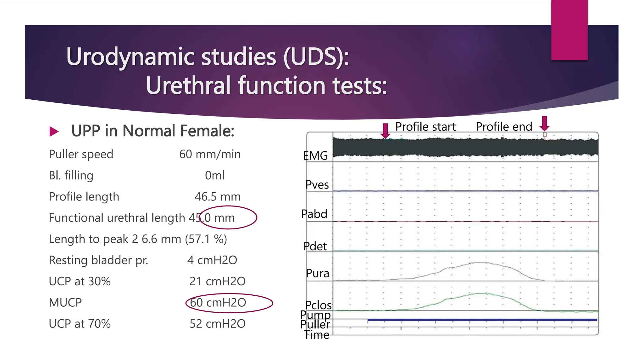Urodynamic studies (UDS):
Urethral function tests:
 UPP in Normal Female:
Puller speed 60 mm/min
Bl. filling 0ml
Profile length 46.5 mm
Functional urethral length 45.0 mm
Length to peak 2 6.6 mm (57.1 %)
Resting bladder pr. 4 cmH2O
UCP at 30% 21 cmH2O
MUCP 60 cmH2O
UCP at 70% 52 cmH2O
Profile start Profile end
EMG
Pves
Pabd
Pdet
Pura
Pclos
Pump
Puller
Time
 