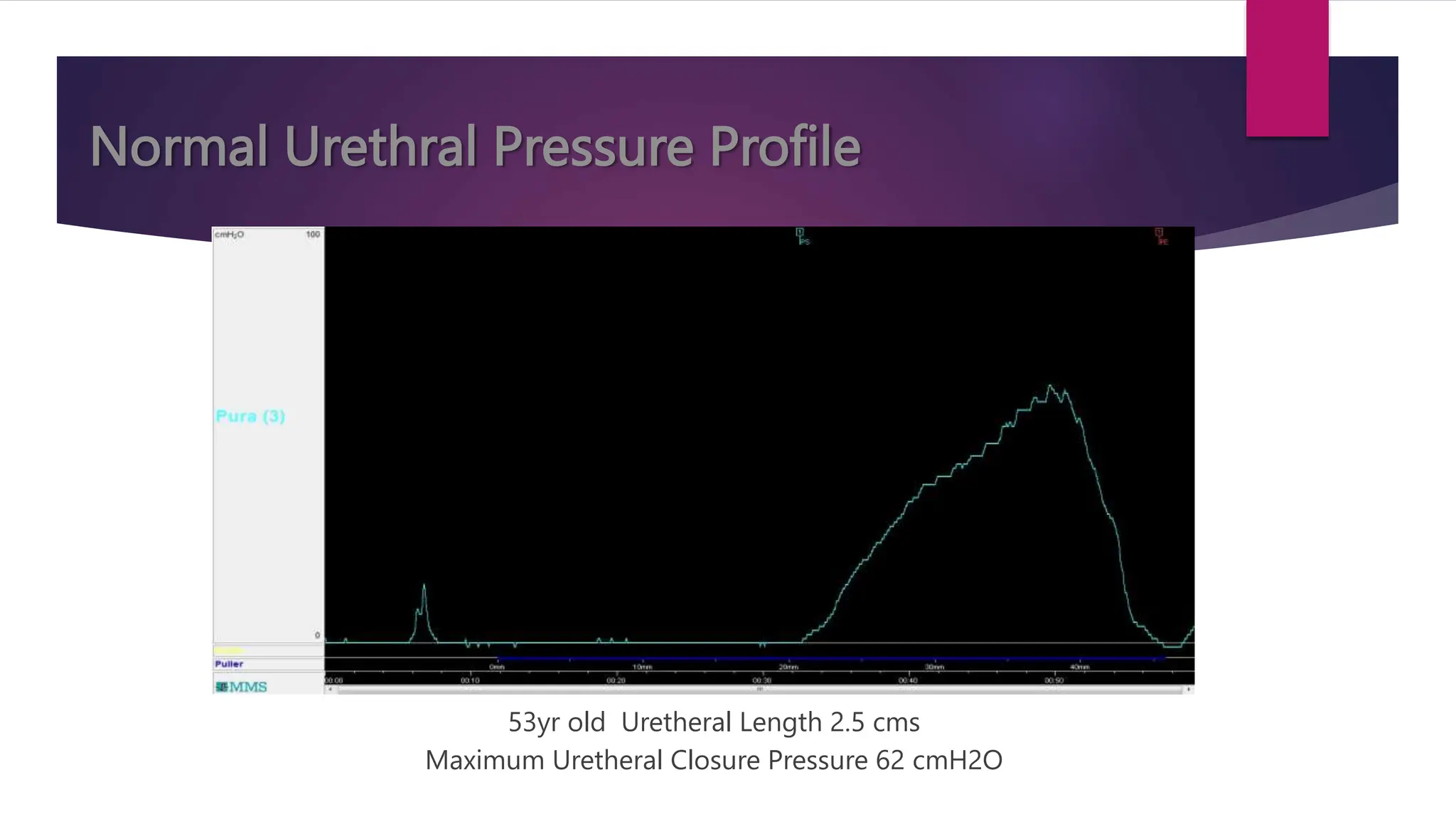 Normal Urethral Pressure Profile
53yr old Uretheral Length 2.5 cms
Maximum Uretheral Closure Pressure 62 cmH2O
 