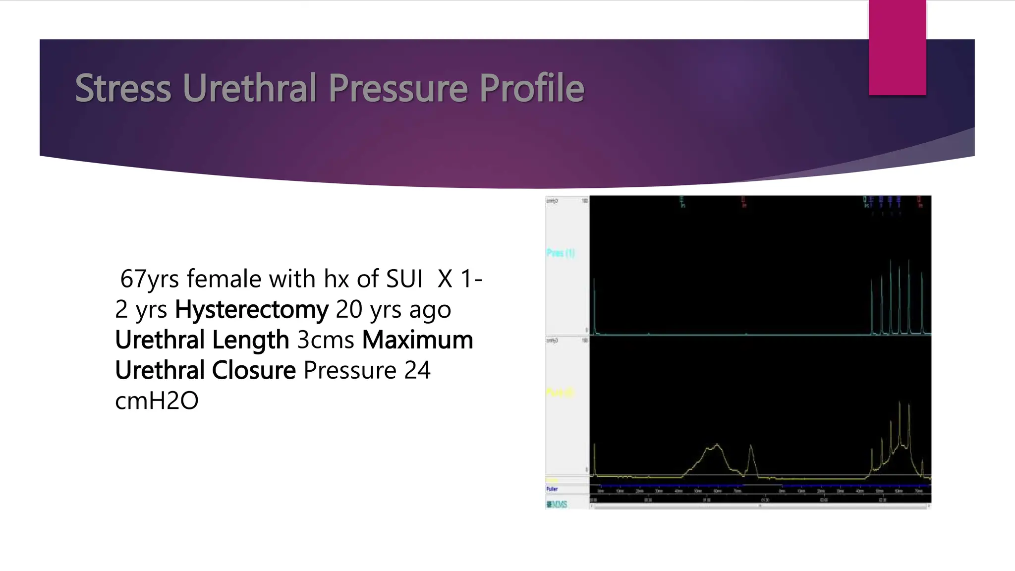 Stress Urethral Pressure Profile
67yrs female with hx of SUI X 1-
2 yrs Hysterectomy 20 yrs ago
Urethral Length 3cms Maximum
Urethral Closure Pressure 24
cmH2O
 