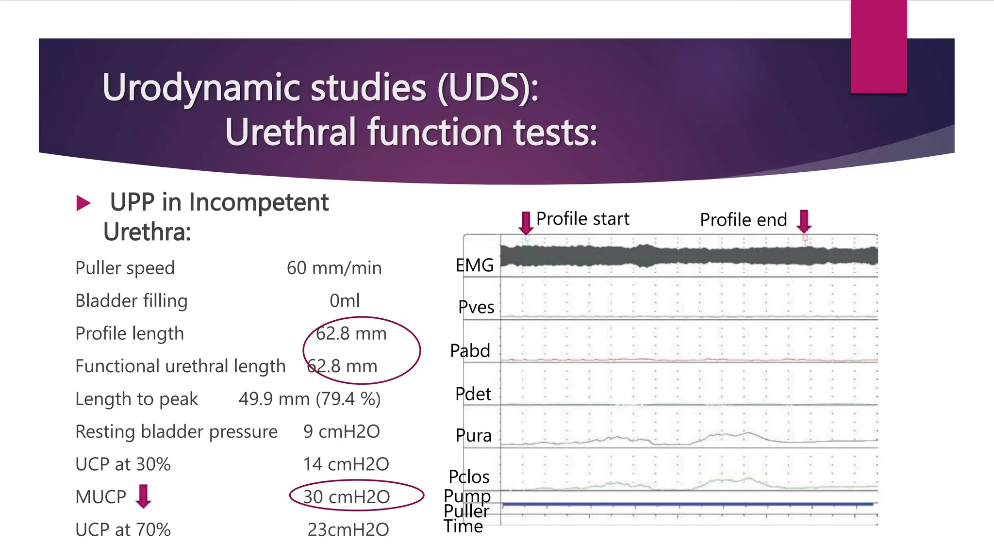 Urodynamic studies (UDS):
Urethral function tests:
 UPP in Incompetent
Urethra:
Puller speed 60 mm/min
Bladder filling 0ml
Profile length 62.8 mm
Functional urethral length 62.8 mm
Length to peak 49.9 mm (79.4 %)
Resting bladder pressure 9 cmH2O
UCP at 30% 14 cmH2O
MUCP 30 cmH2O
UCP at 70% 23cmH2O
Profile start Profile end
EMG
Pves
Pabd
Pdet
Pura
Pclos
Pump
Puller
Time
 