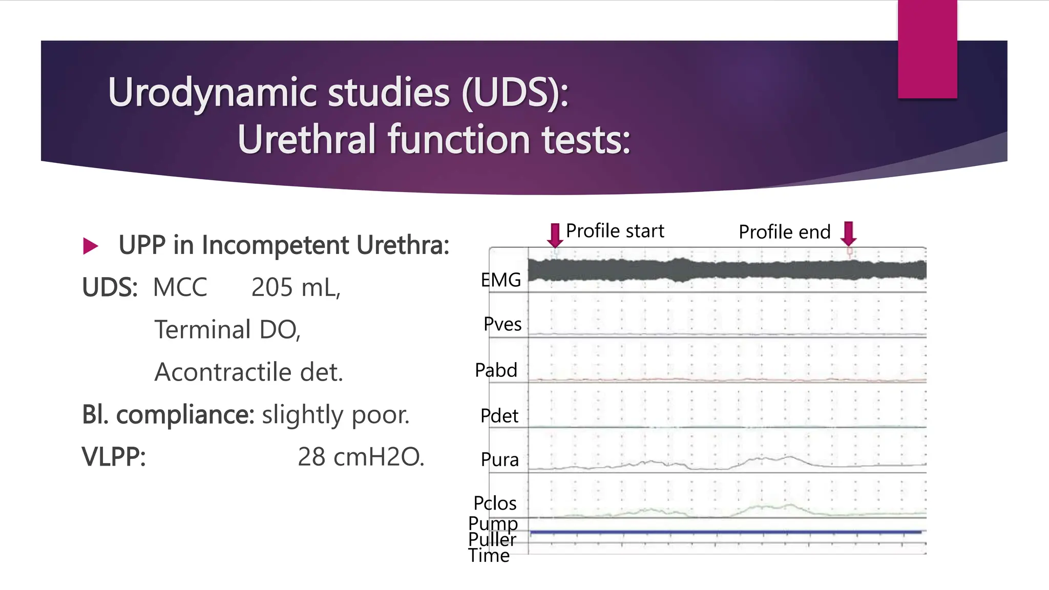 Urodynamic studies (UDS):
Urethral function tests:
 UPP in Incompetent Urethra:
UDS: MCC 205 mL,
Terminal DO,
Acontractile det.
Bl. compliance: slightly poor.
VLPP: 28 cmH2O.
Profile start Profile end
EMG
Pves
Pabd
Pdet
Pura
Pclos
Pump
Puller
Time
 