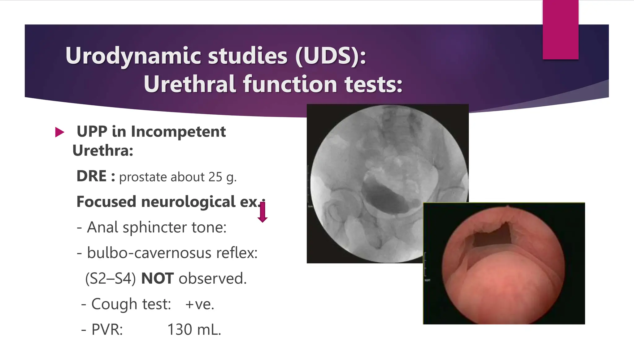 Urodynamic studies (UDS):
Urethral function tests:
 UPP in Incompetent
Urethra:
DRE : prostate about 25 g.
Focused neurological ex.:
- Anal sphincter tone:
- bulbo-cavernosus reflex:
(S2–S4) NOT observed.
- Cough test: +ve.
- PVR: 130 mL.
 