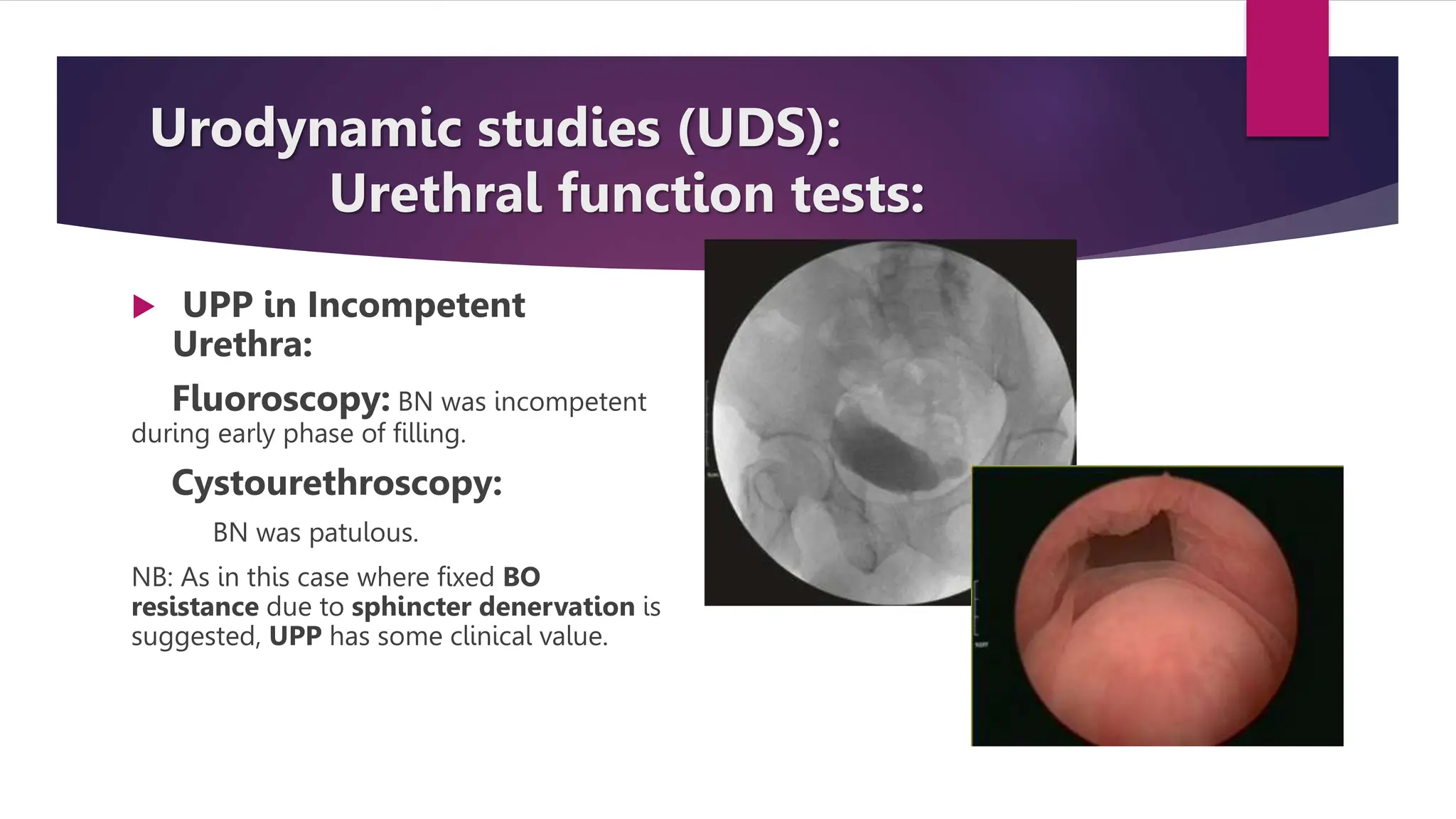 Urodynamic studies (UDS):
Urethral function tests:
 UPP in Incompetent
Urethra:
Fluoroscopy: BN was incompetent
during early phase of filling.
Cystourethroscopy:
BN was patulous.
NB: As in this case where fixed BO
resistance due to sphincter denervation is
suggested, UPP has some clinical value.
 