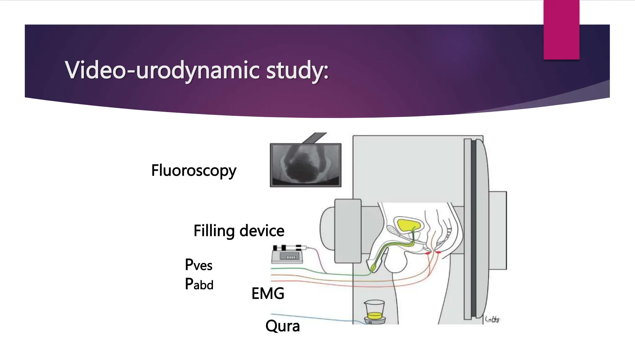 Video-urodynamic study:
Qura
Pves
Pabd
Filling device
EMG
Fluoroscopy
 
