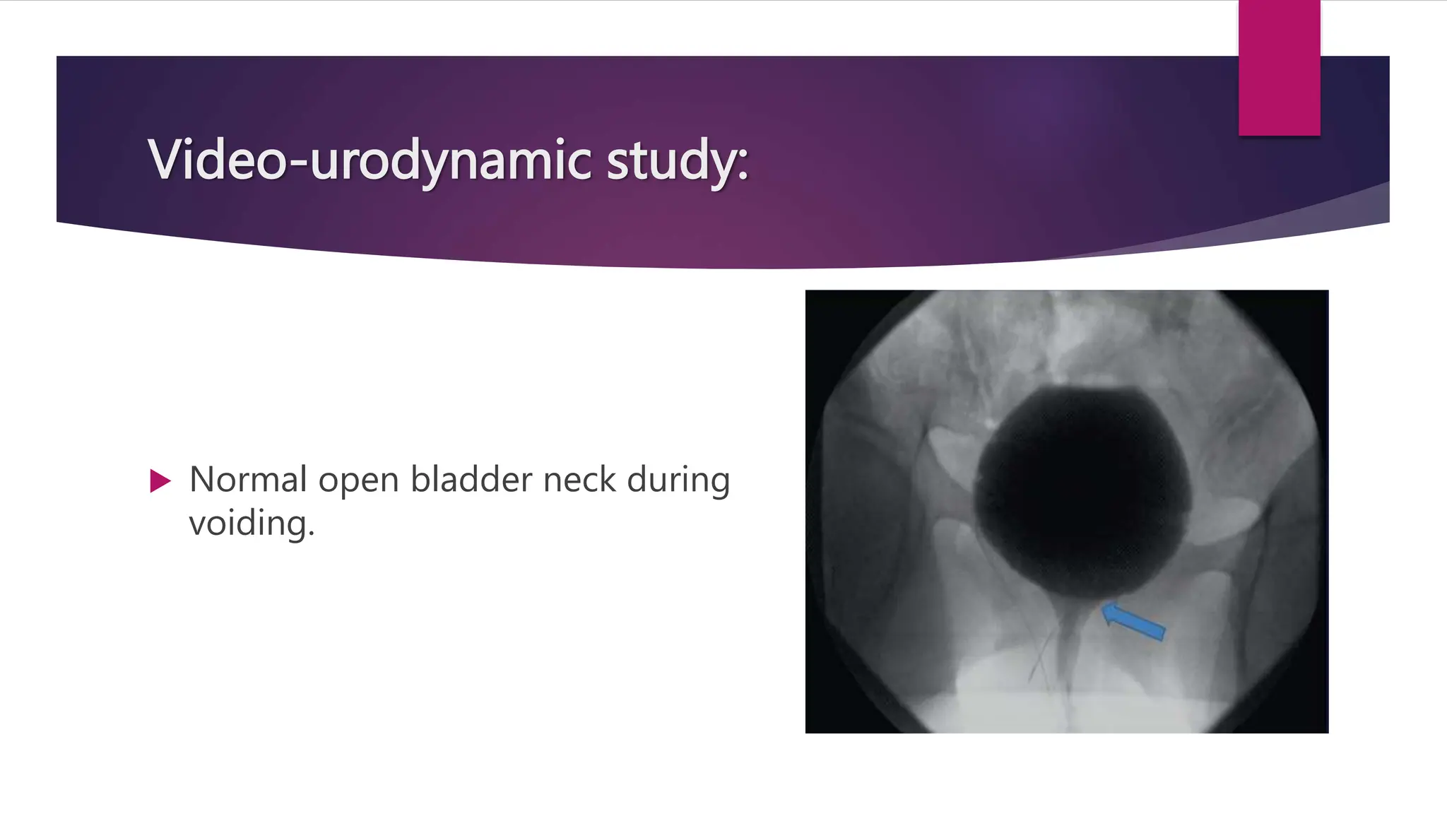 Video-urodynamic study:
 Normal open bladder neck during
voiding.
 