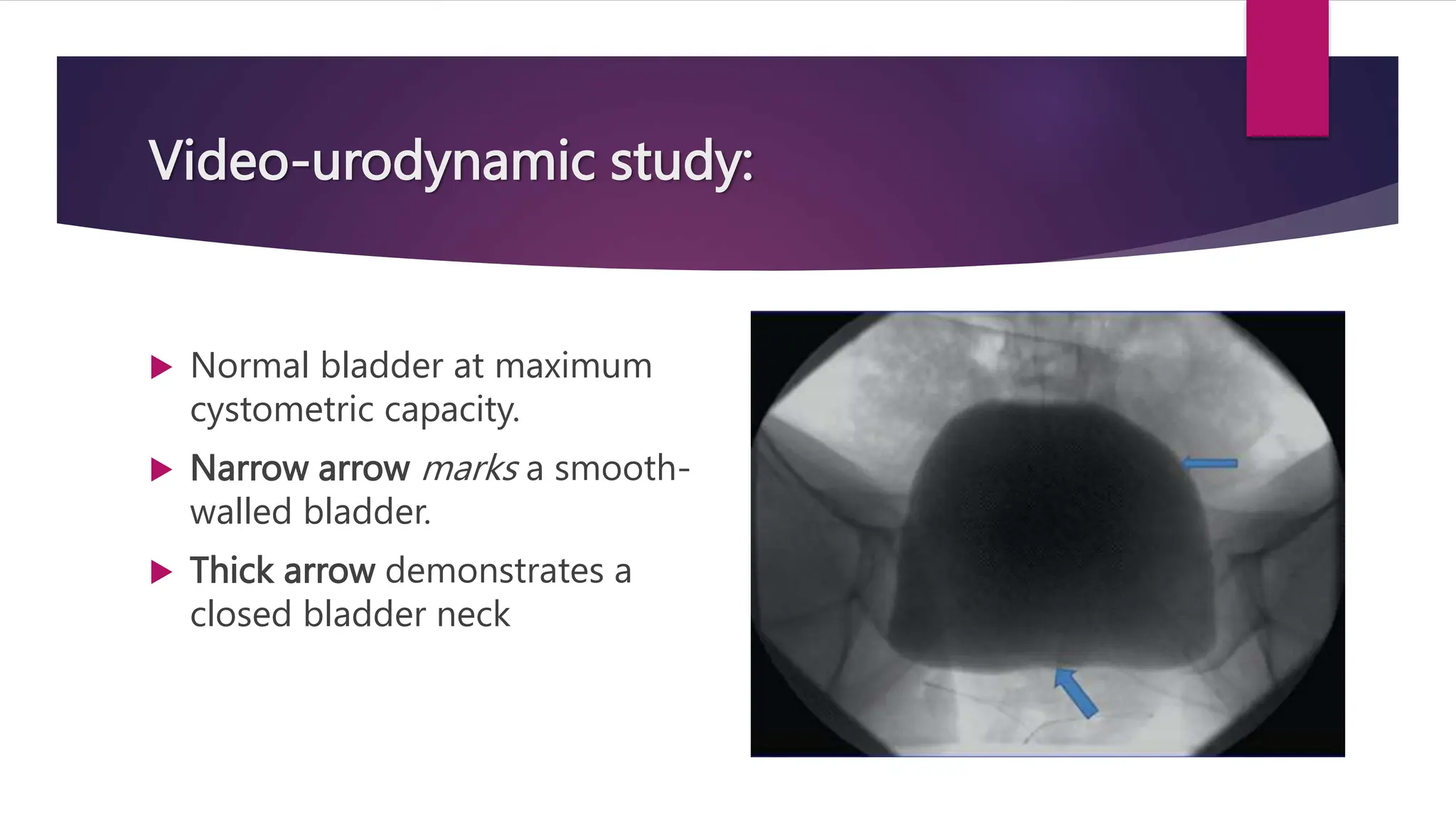Video-urodynamic study:
 Normal bladder at maximum
cystometric capacity.
 Narrow arrow marks a smooth-
walled bladder.
 Thick arrow demonstrates a
closed bladder neck
 