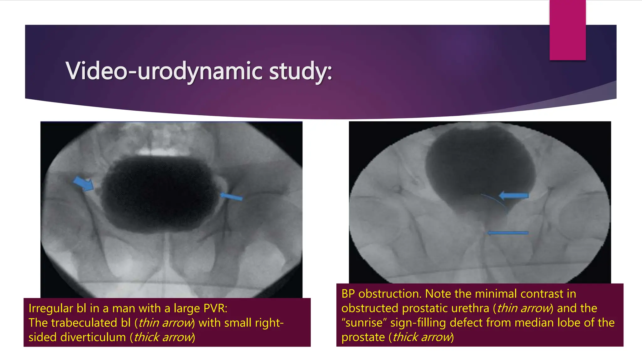 Video-urodynamic study:
Irregular bl in a man with a large PVR:
The trabeculated bl (thin arrow) with small right-
sided diverticulum (thick arrow)
BP obstruction. Note the minimal contrast in
obstructed prostatic urethra (thin arrow) and the
“sunrise” sign-filling defect from median lobe of the
prostate (thick arrow)
 