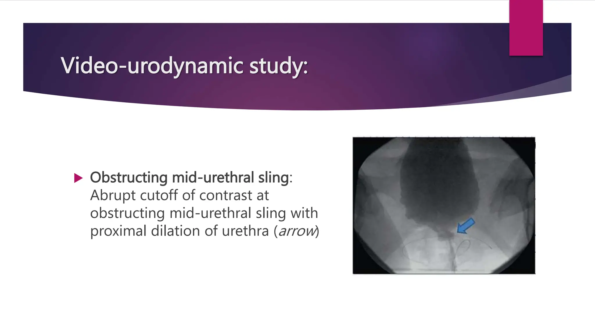 Video-urodynamic study:
 Obstructing mid-urethral sling:
Abrupt cutoff of contrast at
obstructing mid-urethral sling with
proximal dilation of urethra (arrow)
 