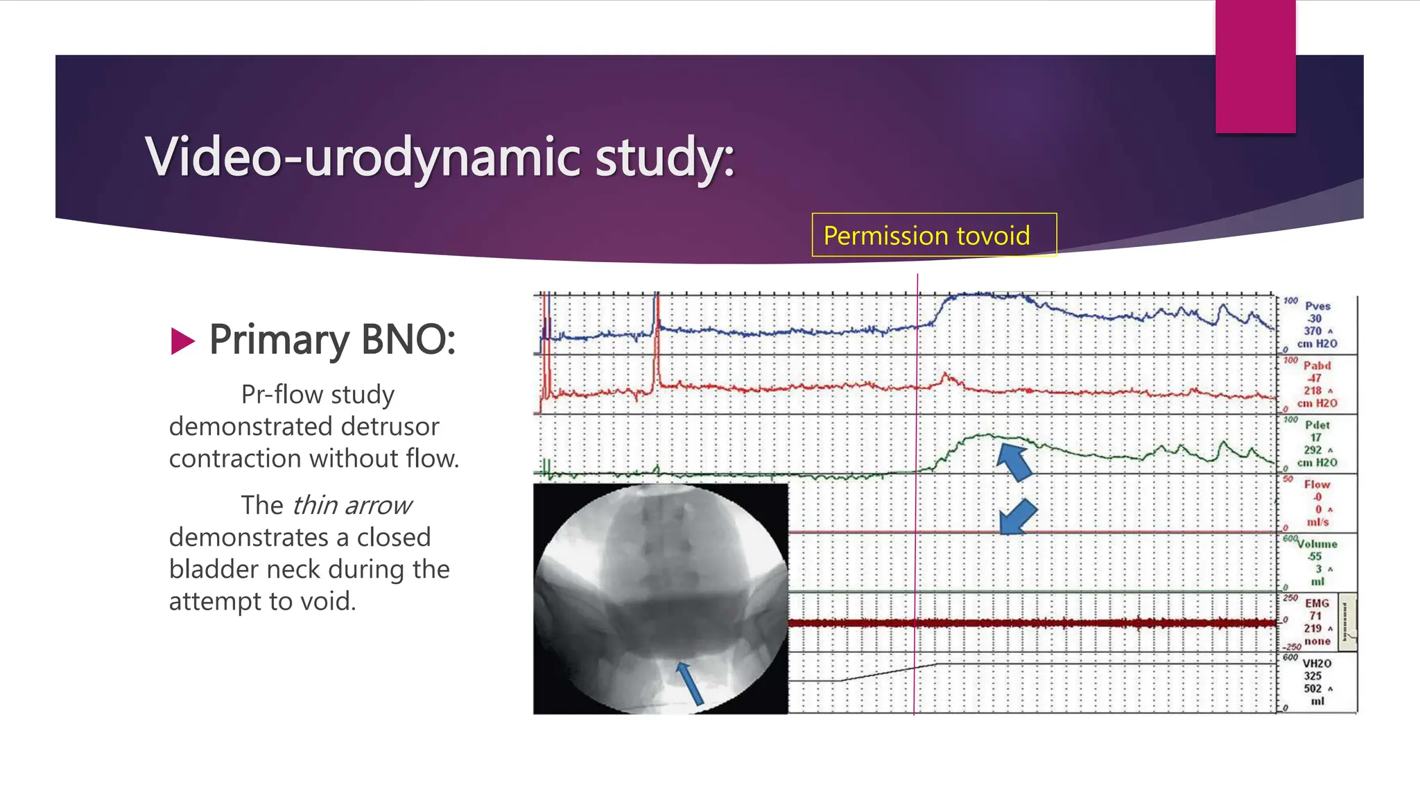 Video-urodynamic study:
 Primary BNO:
Pr-flow study
demonstrated detrusor
contraction without flow.
The thin arrow
demonstrates a closed
bladder neck during the
attempt to void.
Permission tovoid
 