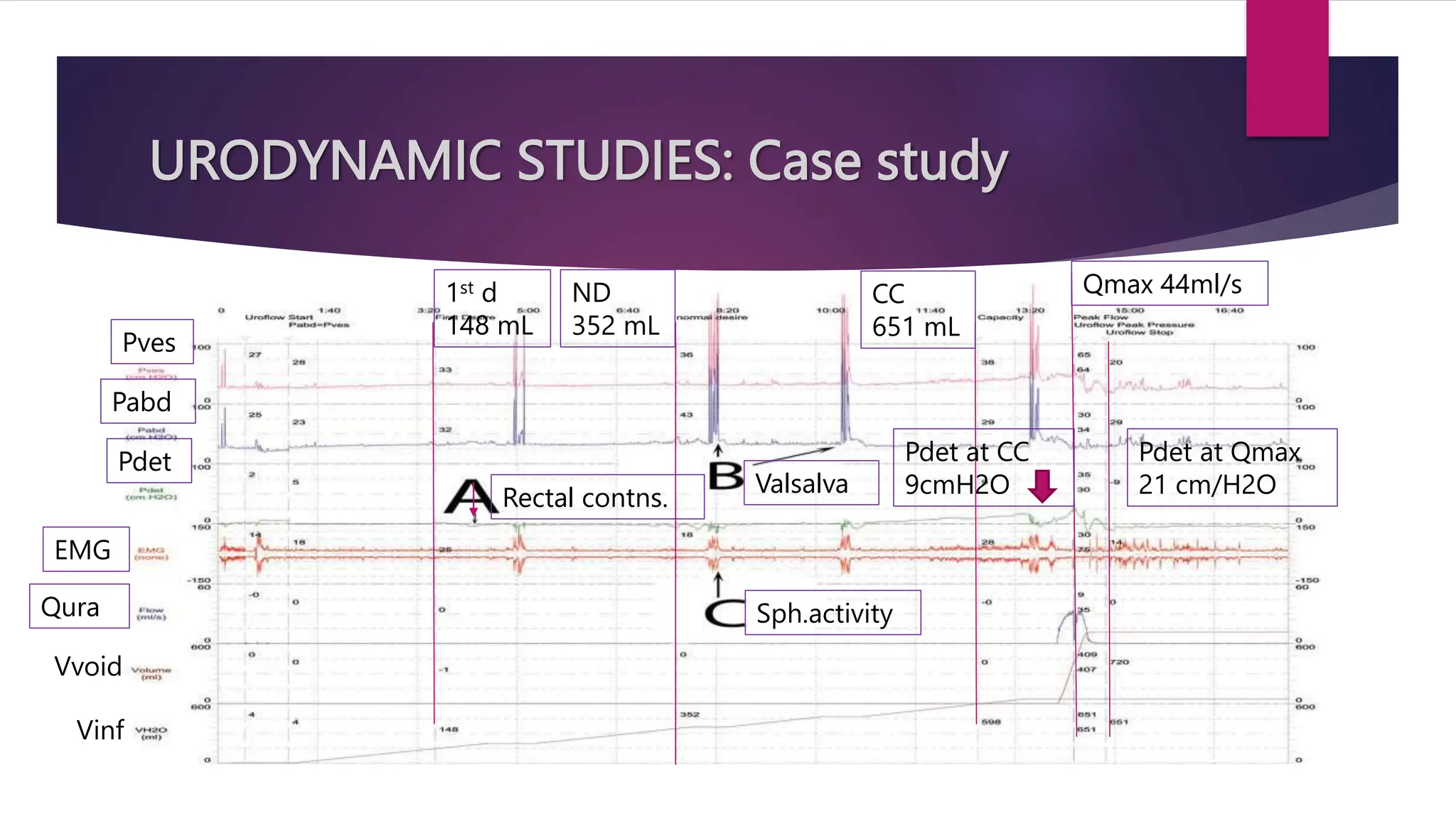 URODYNAMIC STUDIES: Case study
1st d
148 mL
ND
352 mL
CC
651 mL
Qmax 44ml/s
Pves
Pabd
Pdet
Qura
Vvoid
Vinf
EMG
Rectal contns.
Valsalva
Sph.activity
Pdet at CC
9cmH2O
Pdet at Qmax
21 cm/H2O
 