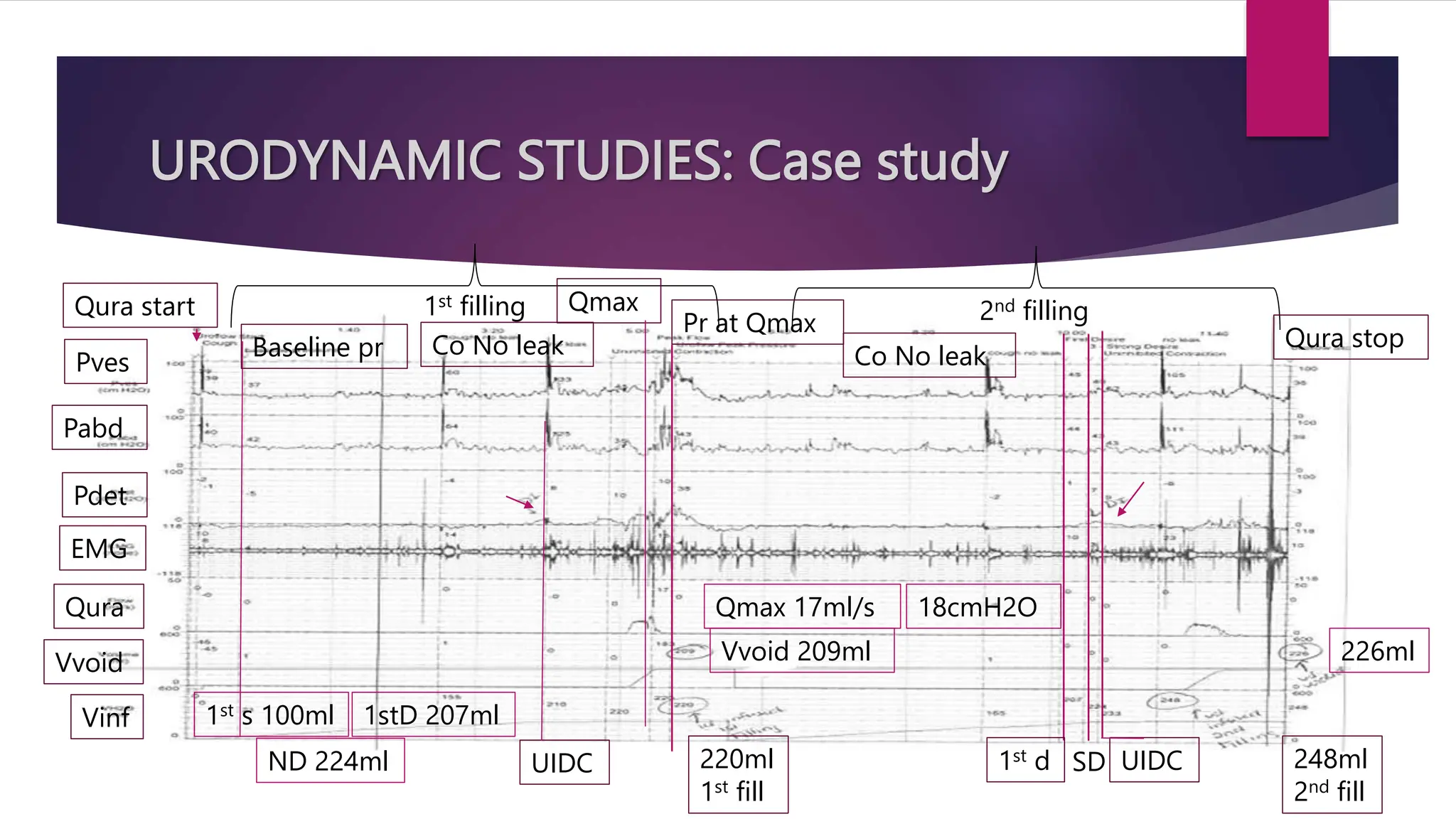 URODYNAMIC STUDIES: Case study
1st filling 2nd filling
Qura start
Baseline pr Co No leak
Qmax
Pr at Qmax
Pves
Pabd
Pdet
Vvoid
Vinf
Qura
EMG
220ml
1st fill
248ml
2nd fill
Co No leak
1st d SD UIDC
Qura stop
UIDC
1st s 100ml
ND 224ml
1stD 207ml
Vvoid 209ml 226ml
Qmax 17ml/s 18cmH2O
 