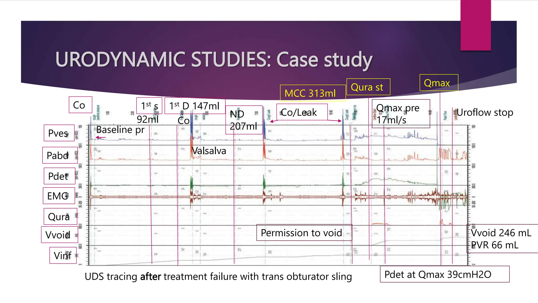URODYNAMIC STUDIES: Case study
UDS tracing after treatment failure with trans obturator sling
Co
Baseline pr
1st s 1st D 147ml
Co
Valsalva
Pves
Pabd
Pdet
EMG
Qura
Vvoid
Vinf
ND
207ml
Co/Leak
Qura st
Qmax pre
17ml/s
Uroflow stop
Qmax
Permission to void
92ml
MCC 313ml
Vvoid 246 mL
PVR 66 mL
Pdet at Qmax 39cmH2O
 