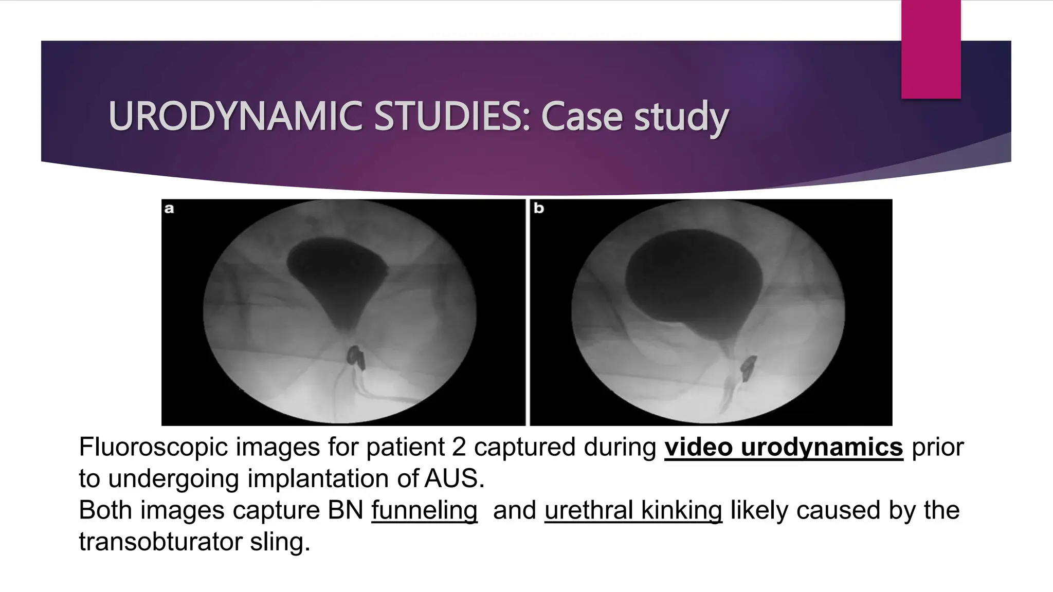 URODYNAMIC STUDIES: Case study
Fluoroscopic images for patient 2 captured during video urodynamics prior
to undergoing implantation of AUS.
Both images capture BN funneling and urethral kinking likely caused by the
transobturator sling.
 