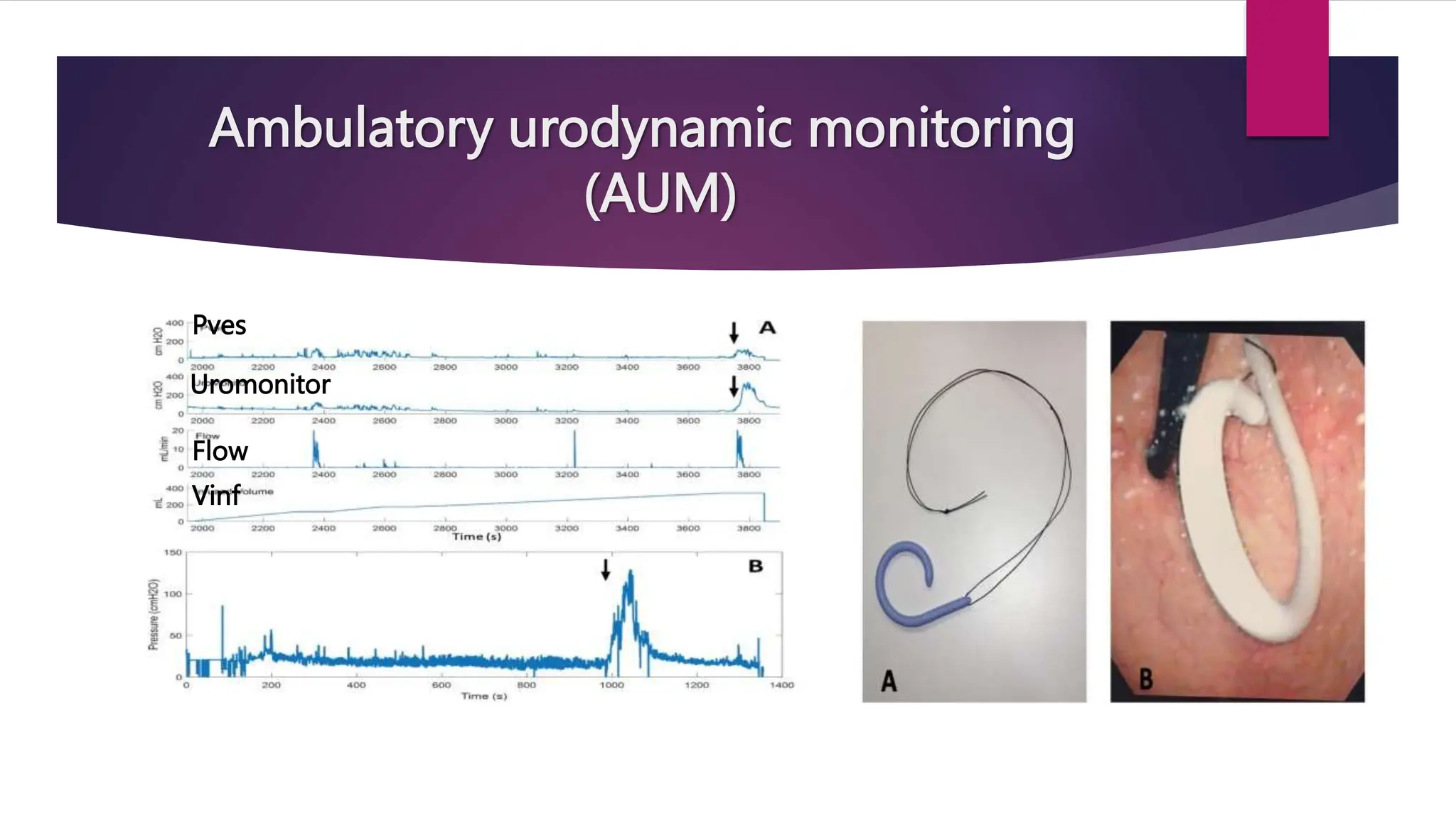 Ambulatory urodynamic monitoring
(AUM)
Pves
Uromonitor
Flow
Vinf
 