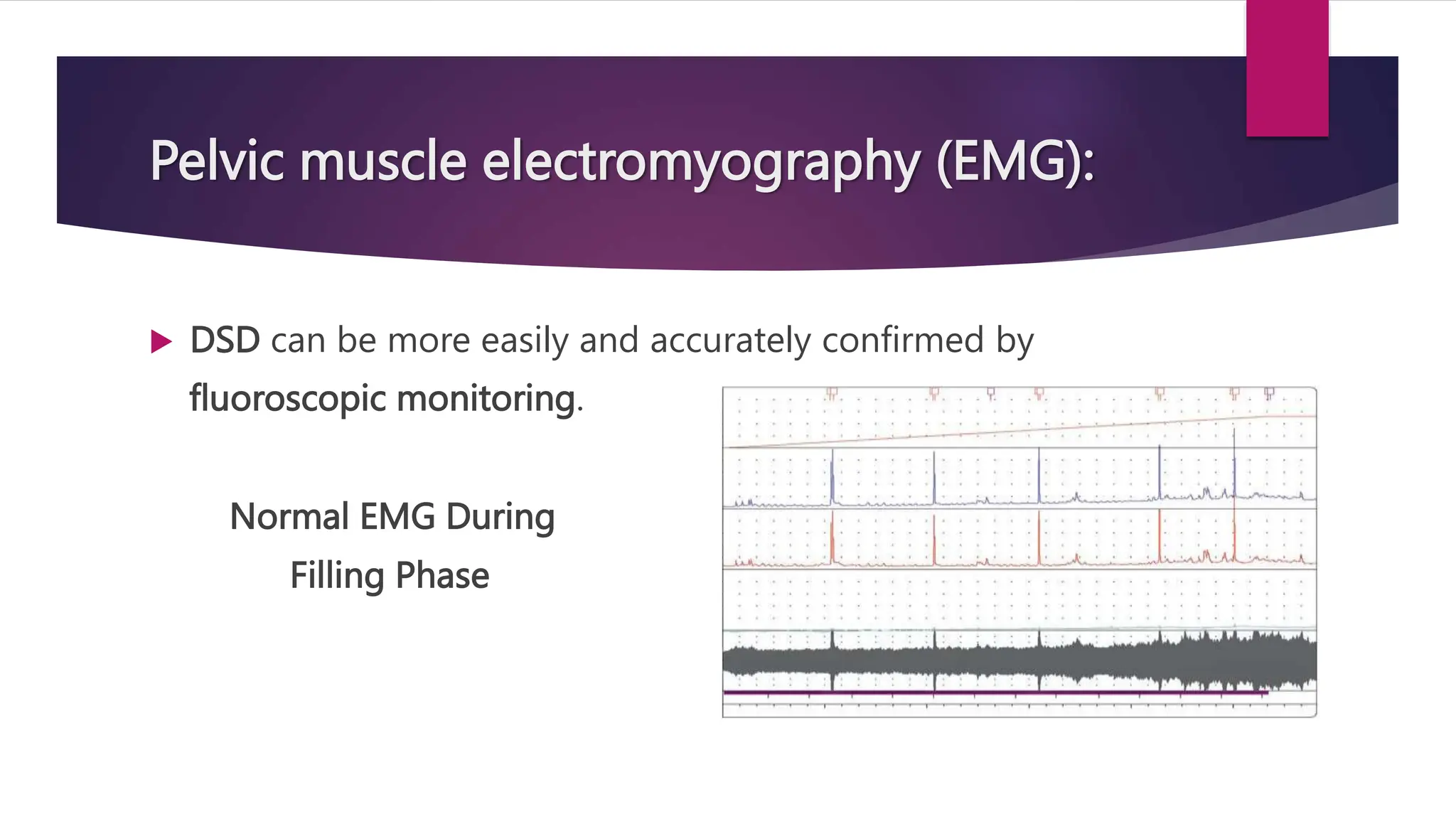  DSD can be more easily and accurately confirmed by
fluoroscopic monitoring.
Normal EMG During
Filling Phase
Pelvic muscle electromyography (EMG):
 