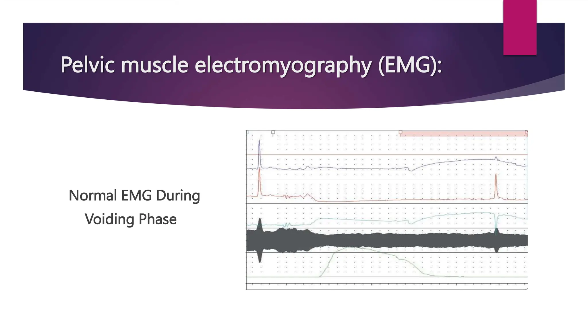 Normal EMG During
Voiding Phase
Pelvic muscle electromyography (EMG):
 