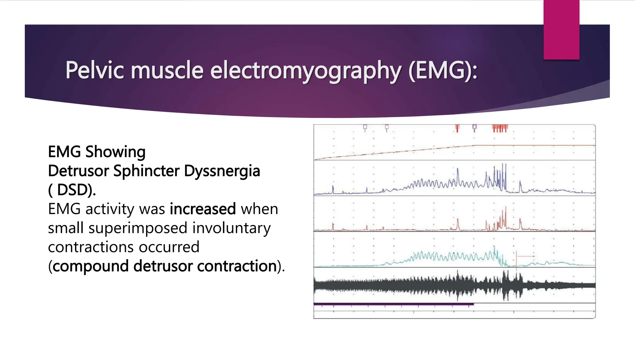 Pelvic muscle electromyography (EMG):
EMG Showing
Detrusor Sphincter Dyssnergia
( DSD).
EMG activity was increased when
small superimposed involuntary
contractions occurred
(compound detrusor contraction).
 