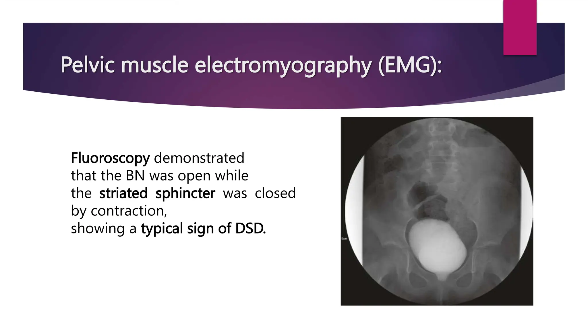 Pelvic muscle electromyography (EMG):
Fluoroscopy demonstrated
that the BN was open while
the striated sphincter was closed
by contraction,
showing a typical sign of DSD.
 