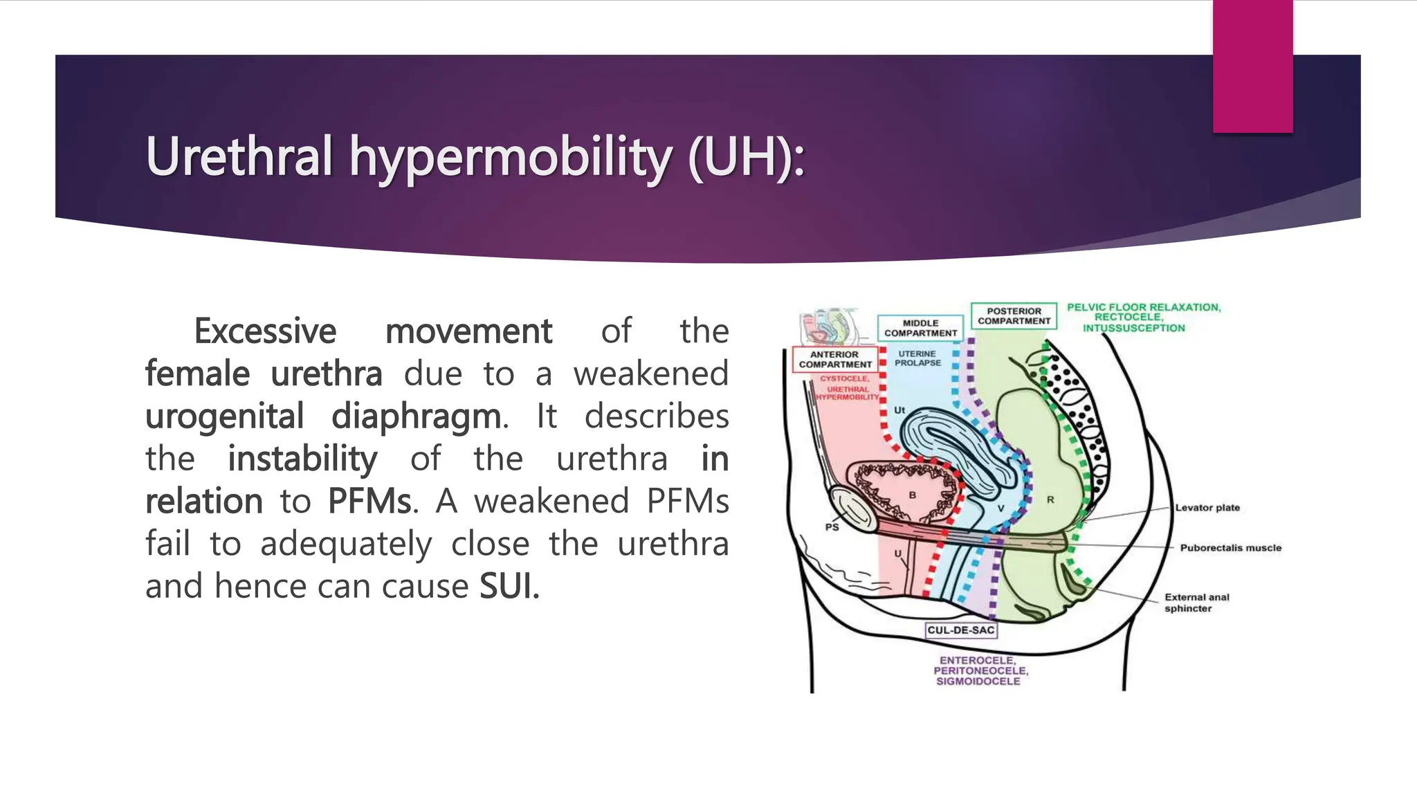 Urethral hypermobility (UH):
Excessive movement of the
female urethra due to a weakened
urogenital diaphragm. It describes
the instability of the urethra in
relation to PFMs. A weakened PFMs
fail to adequately close the urethra
and hence can cause SUI.
 