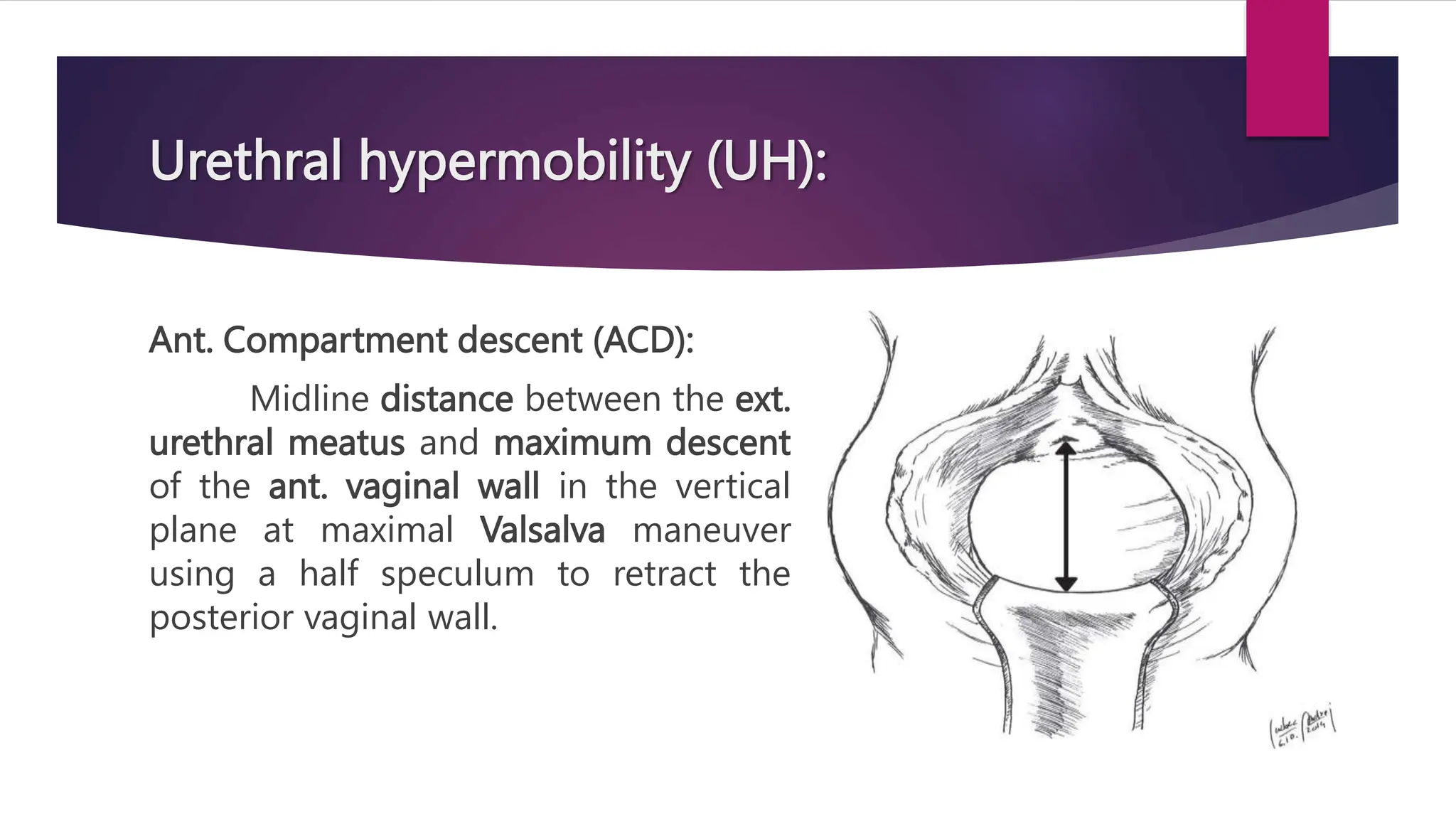 Urethral hypermobility (UH):
Ant. Compartment descent (ACD):
Midline distance between the ext.
urethral meatus and maximum descent
of the ant. vaginal wall in the vertical
plane at maximal Valsalva maneuver
using a half speculum to retract the
posterior vaginal wall.
 