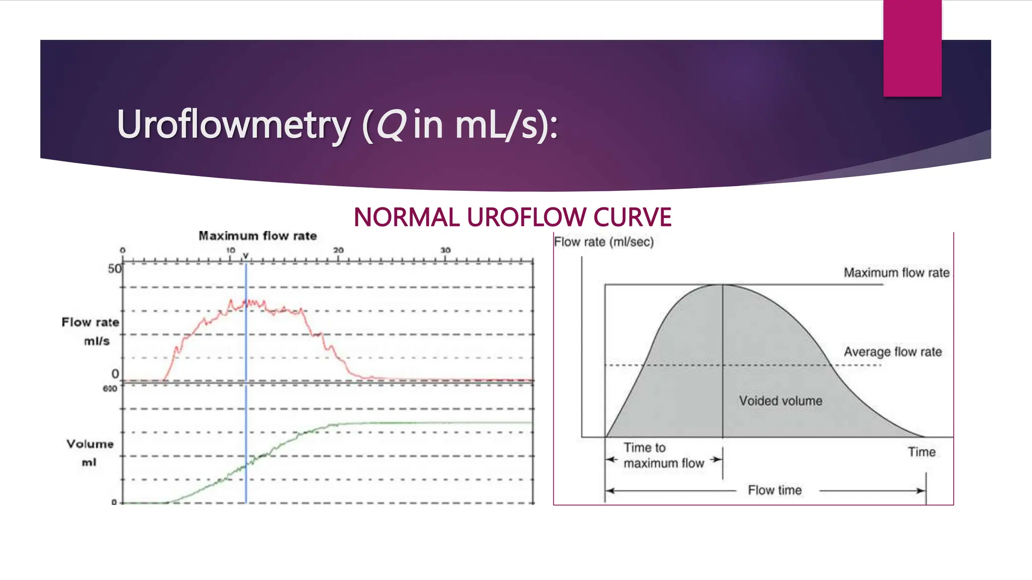 Uroflowmetry (Q in mL/s):
NORMAL UROFLOW CURVE
 