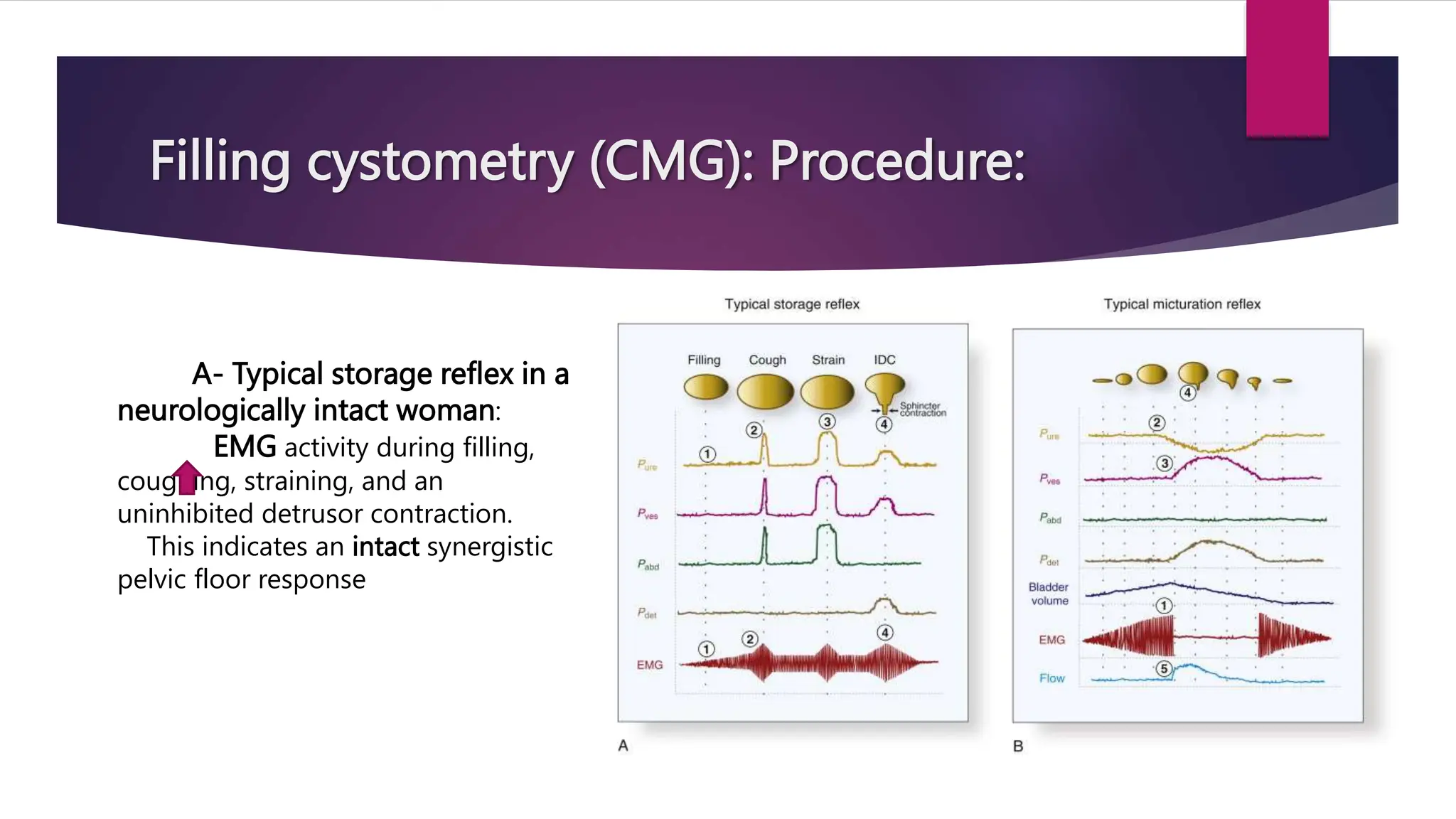Filling cystometry (CMG): Procedure:
A- Typical storage reflex in a
neurologically intact woman:
EMG activity during filling,
coughing, straining, and an
uninhibited detrusor contraction.
This indicates an intact synergistic
pelvic floor response
 