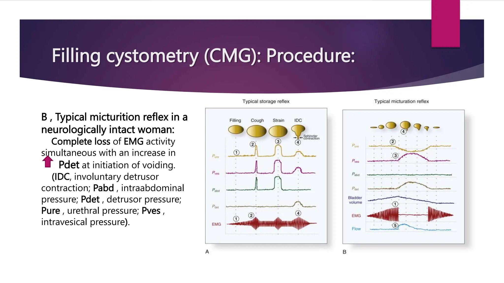 Filling cystometry (CMG): Procedure:
B , Typical micturition reflex in a
neurologically intact woman:
Complete loss of EMG activity
simultaneous with an increase in
Pdet at initiation of voiding.
(IDC, involuntary detrusor
contraction; Pabd , intraabdominal
pressure; Pdet , detrusor pressure;
Pure , urethral pressure; Pves ,
intravesical pressure).
 
