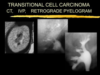 Retained Pyelogram Ct uroepithelial neoplasms.ppt