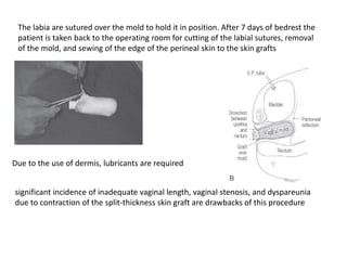 Urogenial sinus and vagial atresias | PPTX