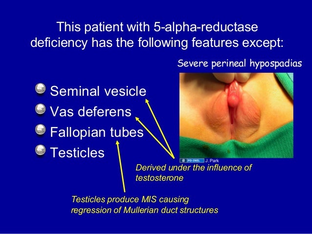 Perineal Hypospadias 37 Perineal Hypospadias 37