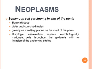 NEOPLASMS
 Squamous cell carcinoma in situ of the penis
 Bowendisease
 older uncircumcised males
 grossly as a solitary plaque on the shaft of the penis.
 Histologic examination reveals morphologically
malignant cells throughout the epidermis with no
invasion of the underlying stroma
16
 