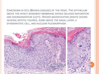 CARCINOMA IN SITU (BOWEN DISEASE) OF THE PENIS. THE EPITHELIUM
ABOVE THE INTACT BASEMENT MEMBRANE SHOWS DELAYED MATURATION
AND DISORGANIZATION (LEFT). HIGHER MAGNIFICATION (RIGHT) SHOWS
SEVERAL MITOTIC FIGURES, SOME ABOVE THE BASAL LAYER, A
DYSKERATOTIC CELL, AND NUCLEAR PLEOMORPHISM.
17
 
