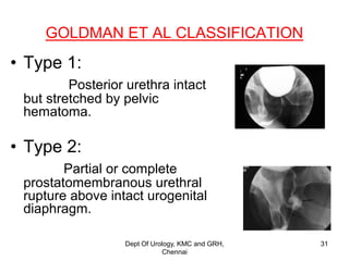 GOLDMAN ET AL CLASSIFICATION
• Type 1:
Posterior urethra intact
but stretched by pelvic
hematoma.
• Type 2:
Partial or complete
prostatomembranous urethral
rupture above intact urogenital
diaphragm.
Dept Of Urology, KMC and GRH,
Chennai
31
 