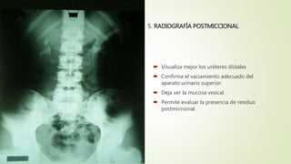 5. RADIOGRAFÍA POSTMICCIONAL
 Visualiza mejor los uréteres distales
 Confirma el vaciamiento adecuado del
aparato urinario superior.
 Deja ver la mucosa vesical.
 Permite evaluar la presencia de residuo
postmiccional.
 