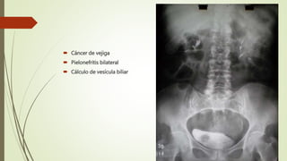  Cáncer de vejiga
 Pielonefritis bilateral
 Cálculo de vesícula biliar
 