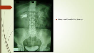  Mala rotación del riñón derecho
 