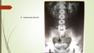  Ureterocele derecha
 