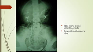  Doble sistema excretor
bilateral incompleto
 Compresión extrínseca en la
vejiga
 