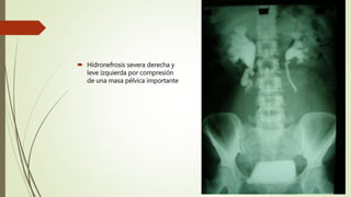  Hidronefrosis severa derecha y
leve izquierda por compresión
de una masa pélvica importante
 
