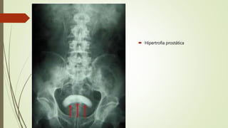  Hipertrofia prostática
 