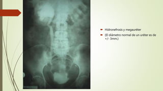  Hidronefrosis y megauréter
 (El diámetro normal de un uréter es de
+/- 3mm.)
 