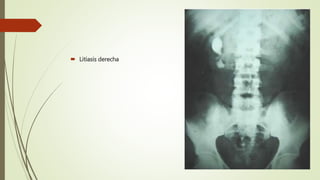  Litiasis derecha
 